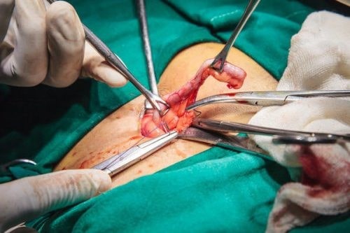 آپاندیسیت حاد، شایع ترین اورژانس جراحی